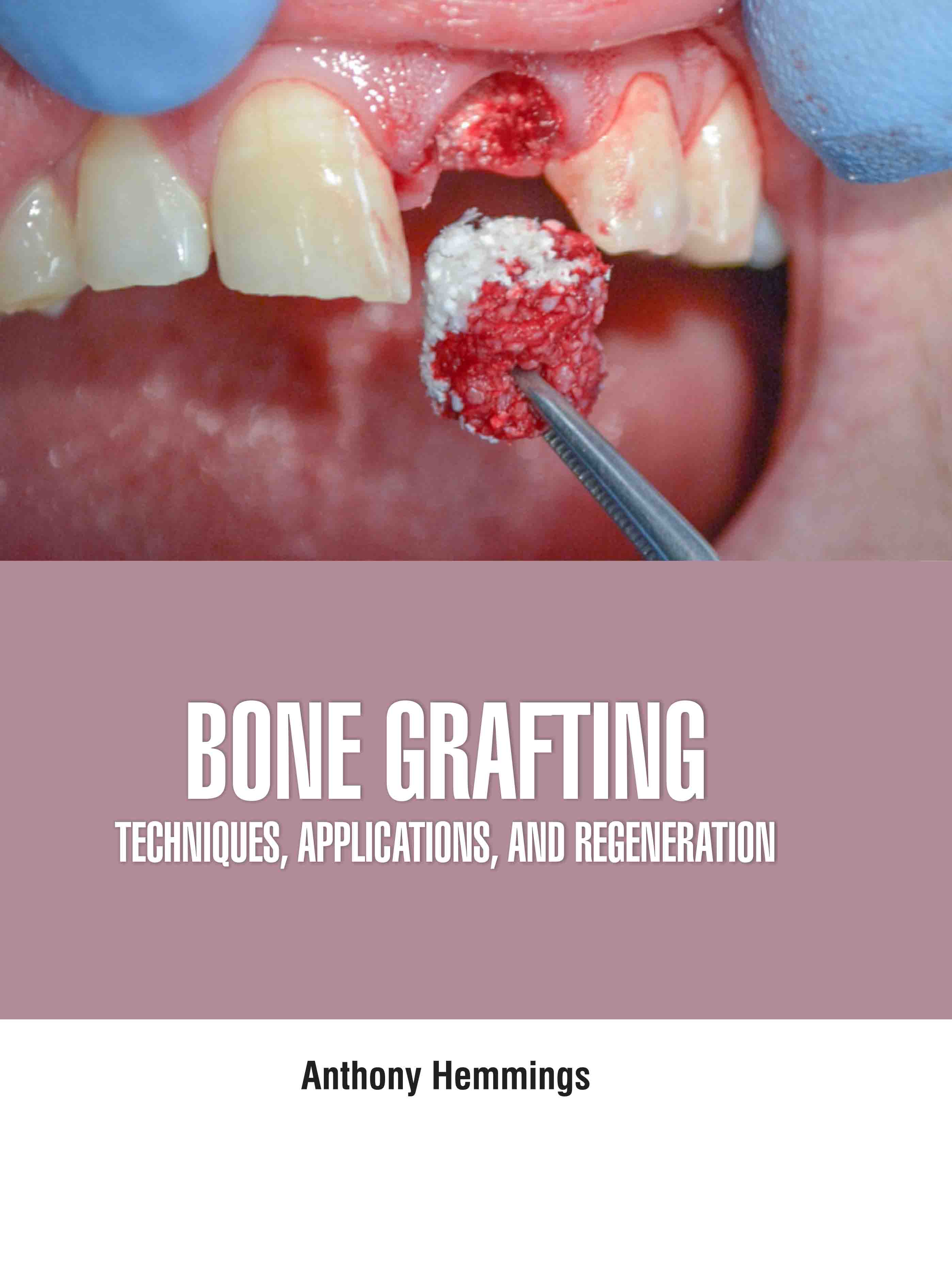 Bone Grafting: Techniques, Applications, and Regeneration
