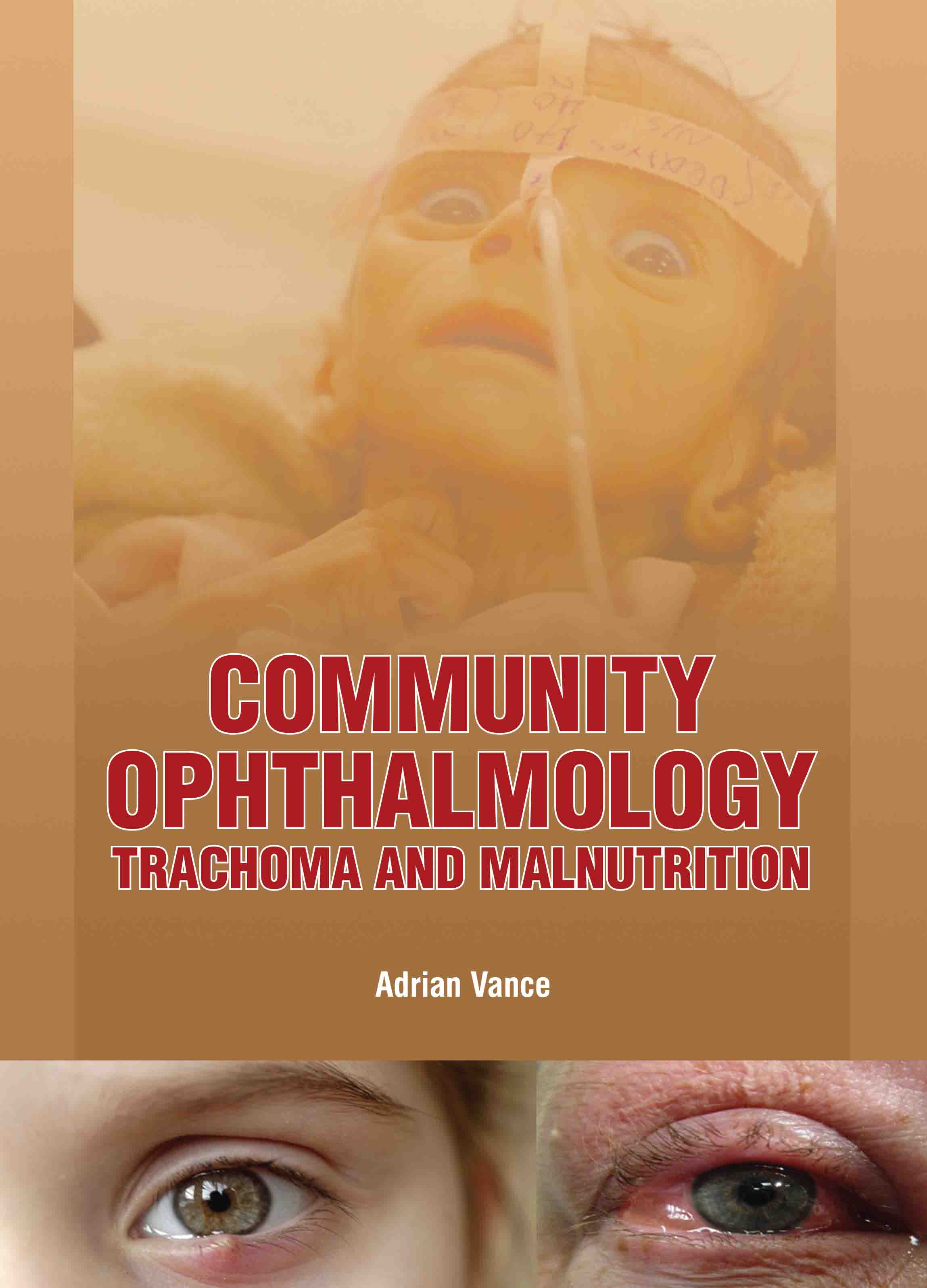Community Ophthalmology: Trachoma and Malnutrition