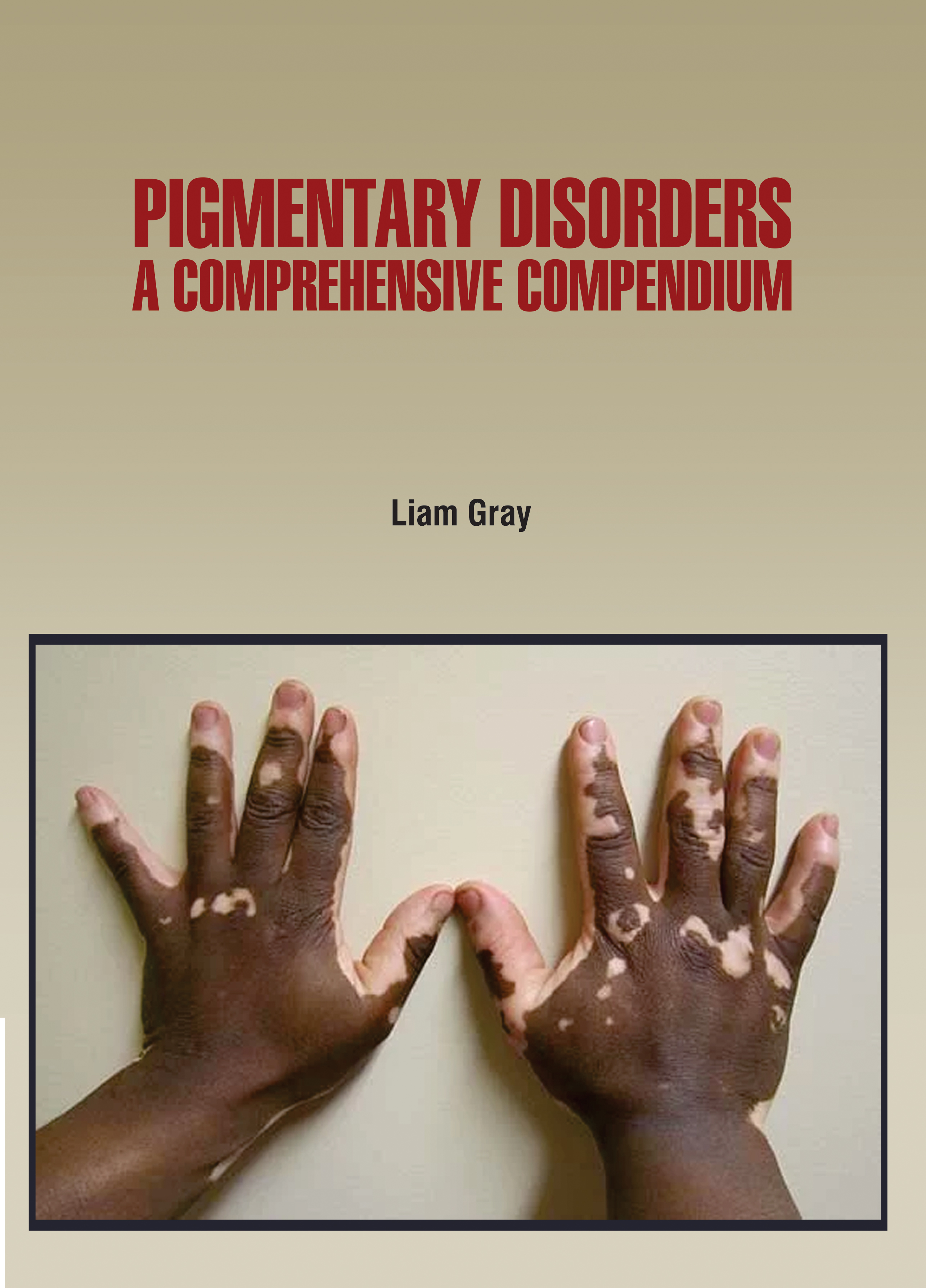 Pigmentary Disorders A Comprehensive Compendium