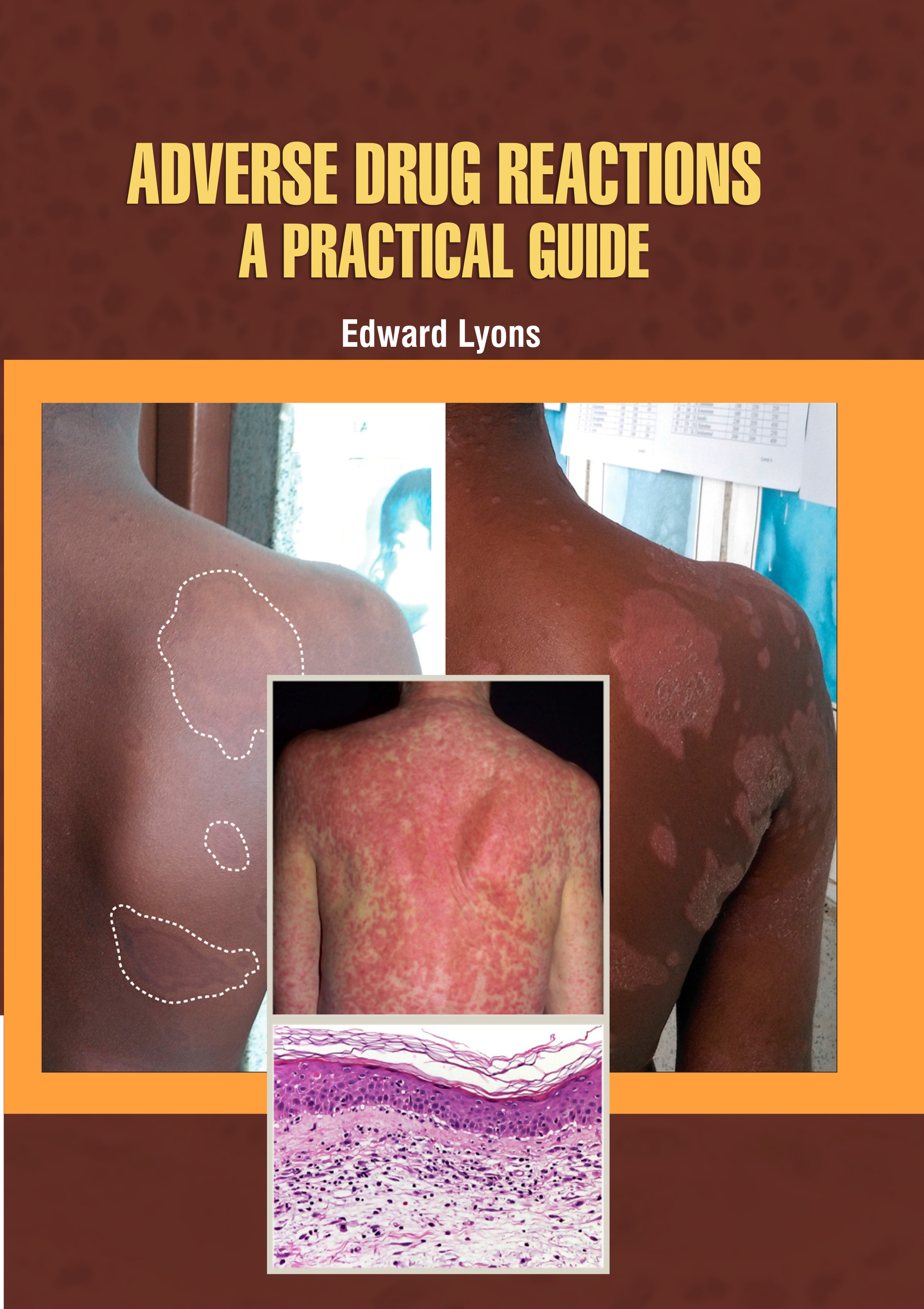 Adverse Drug Reactions: A Practical Guide