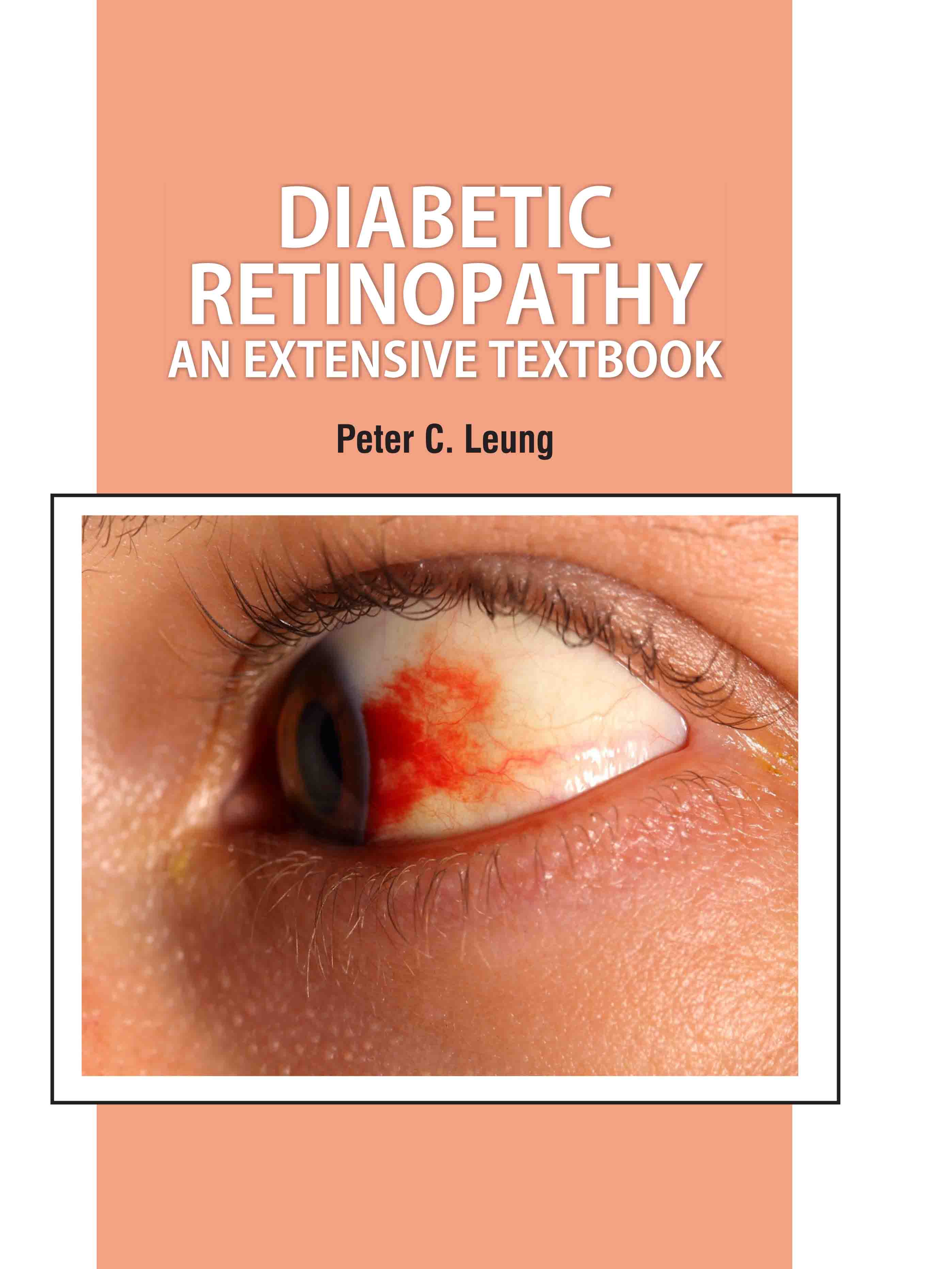 Diabetic Retinopathy: An Extensive Textbook