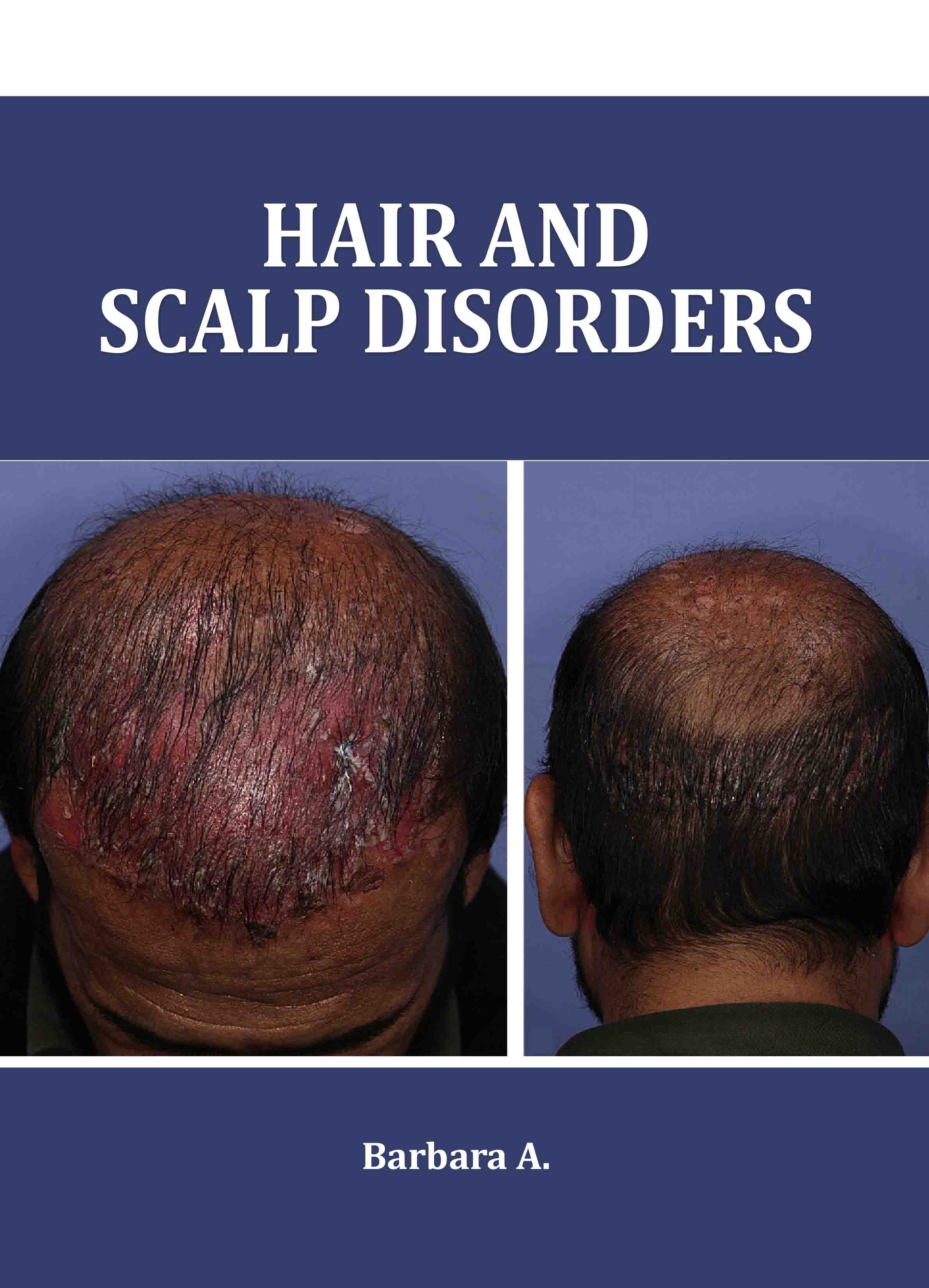 Hair and Scalp Disorders