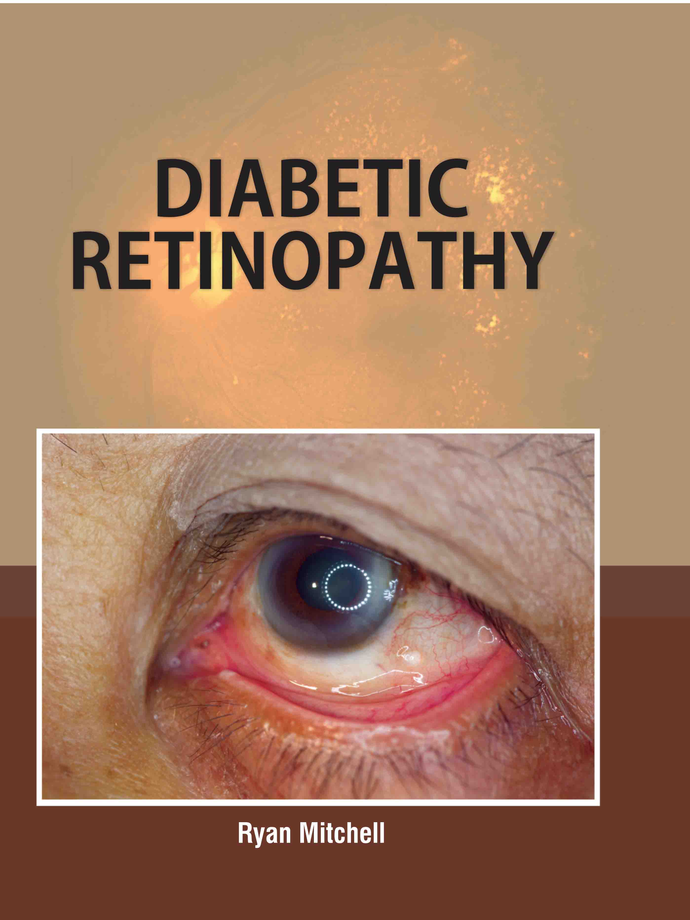 Diabetic Retinopathy