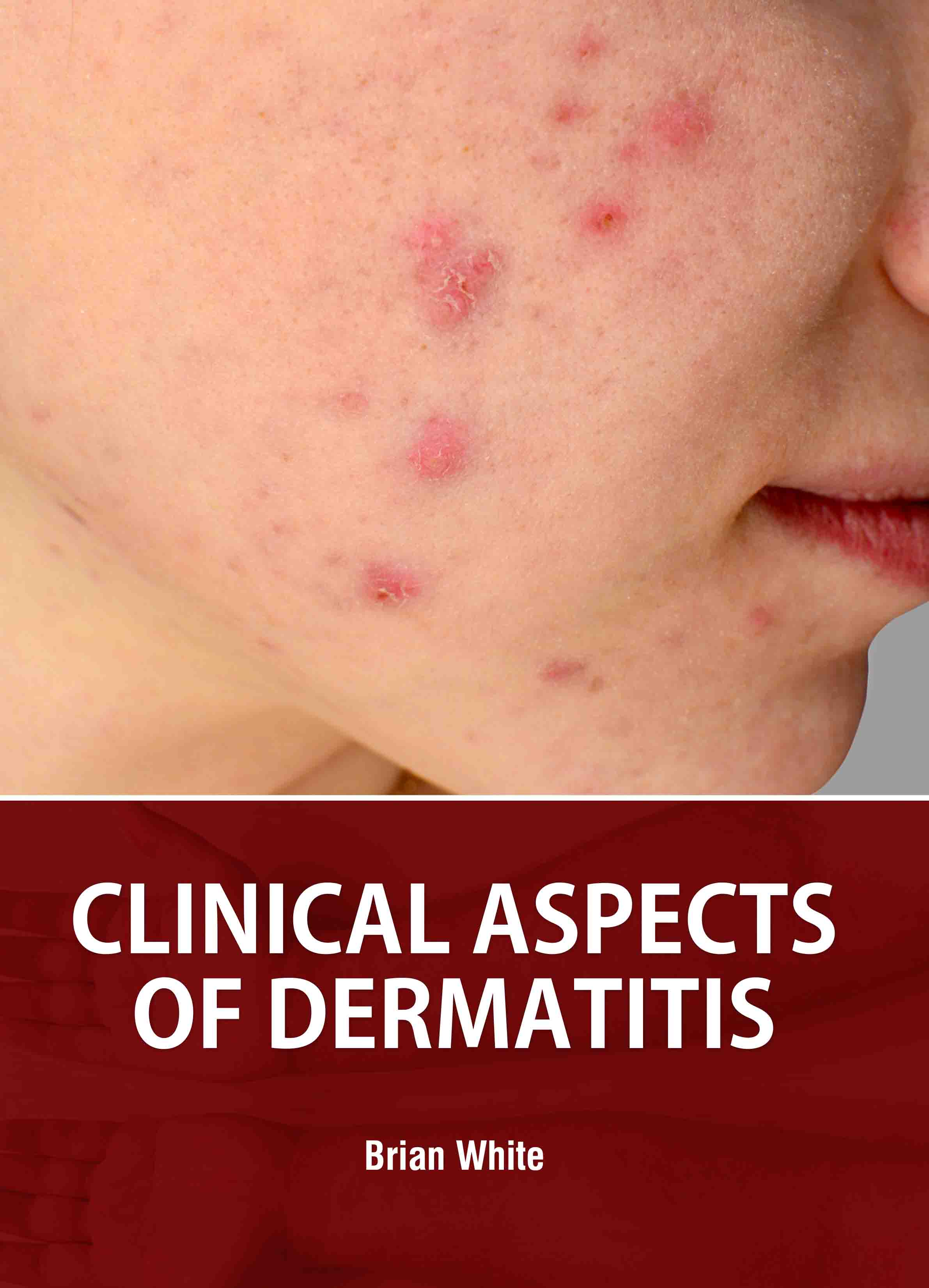 Clinical Aspects of Dermatitis