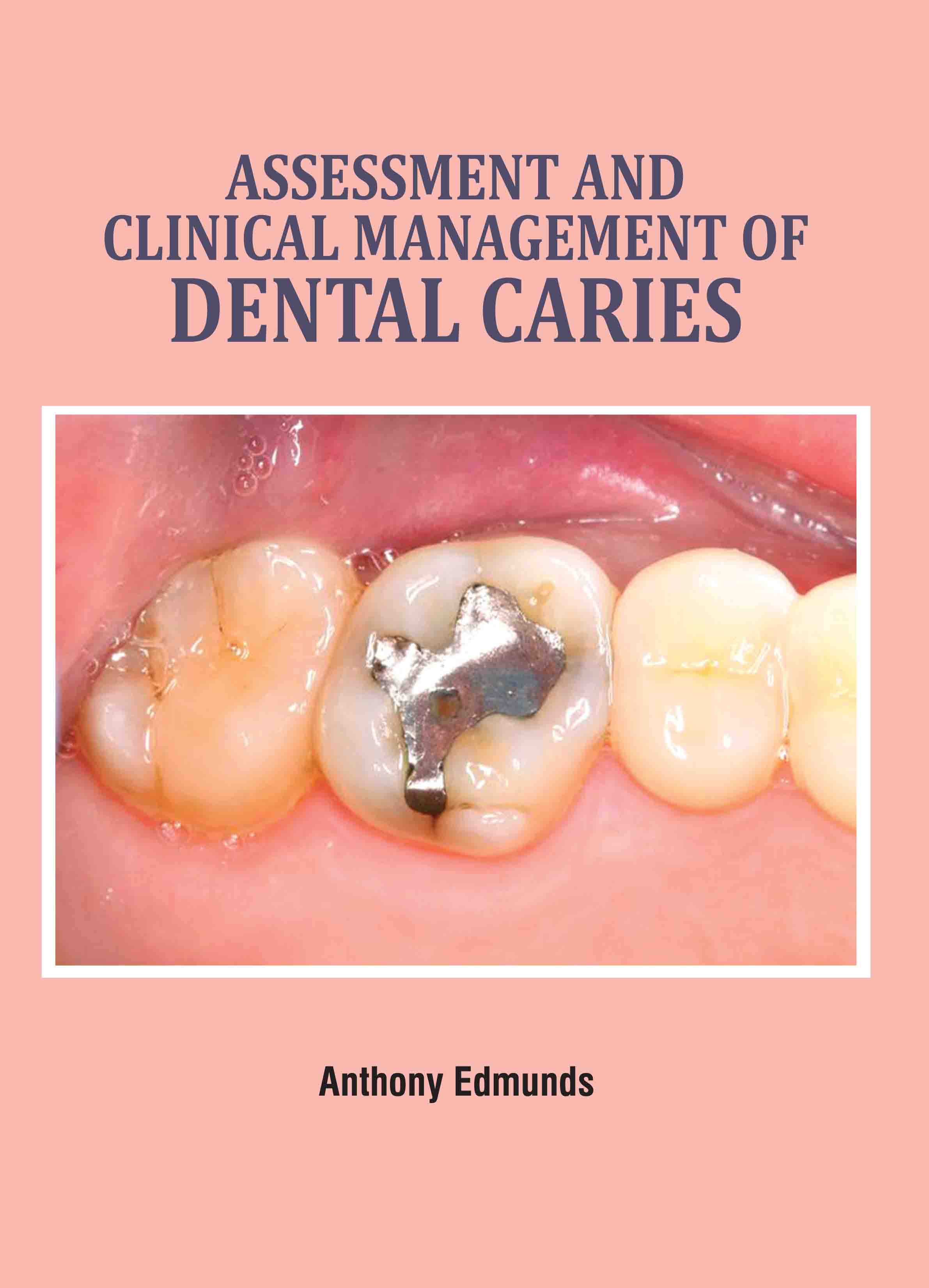 Assessment and Clinical Management of Dental Caries
