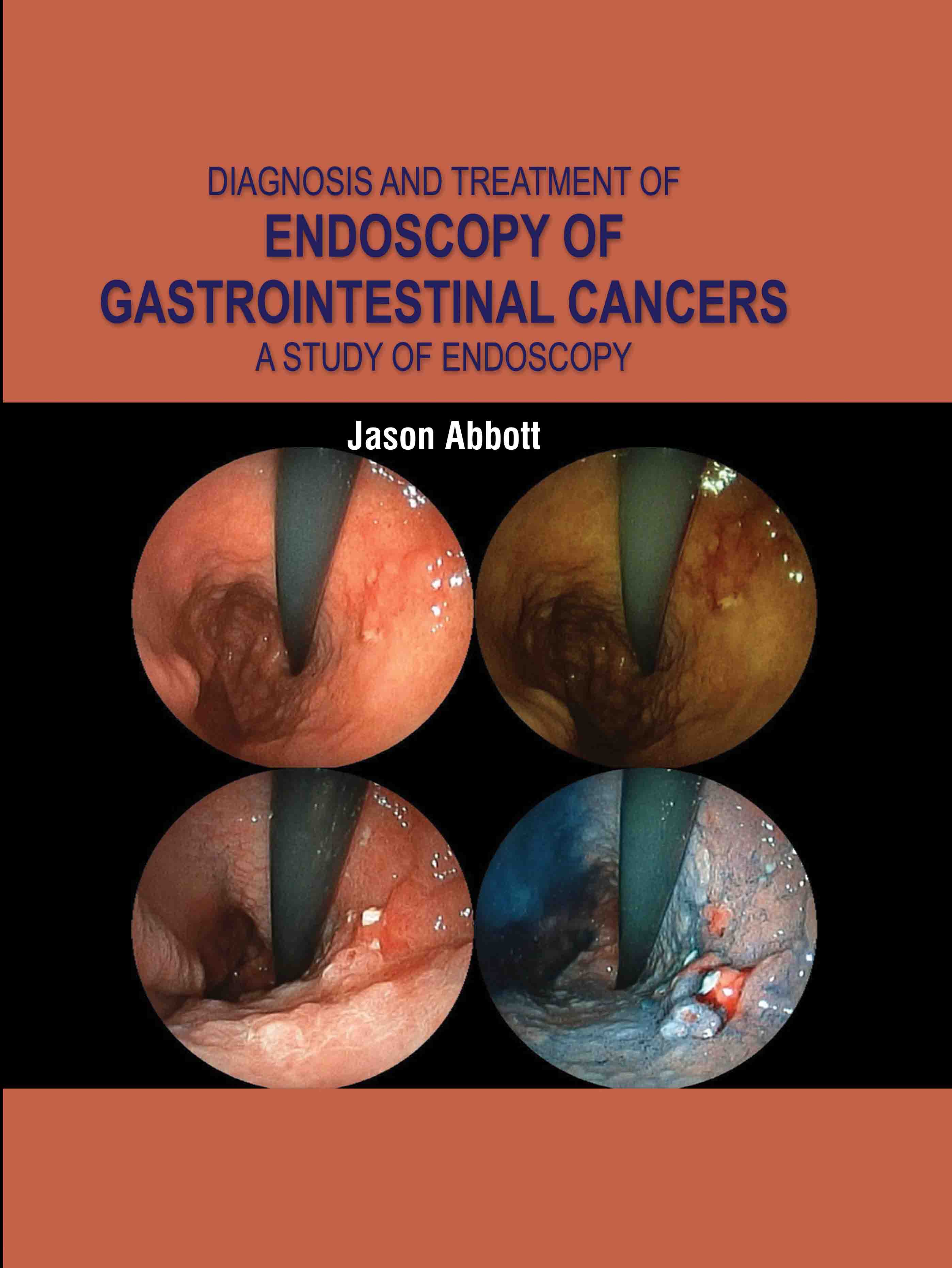 Diagnosis and Treatment of Endoscopy of Gastrointestinal Cancers: A Study of Endoscopy