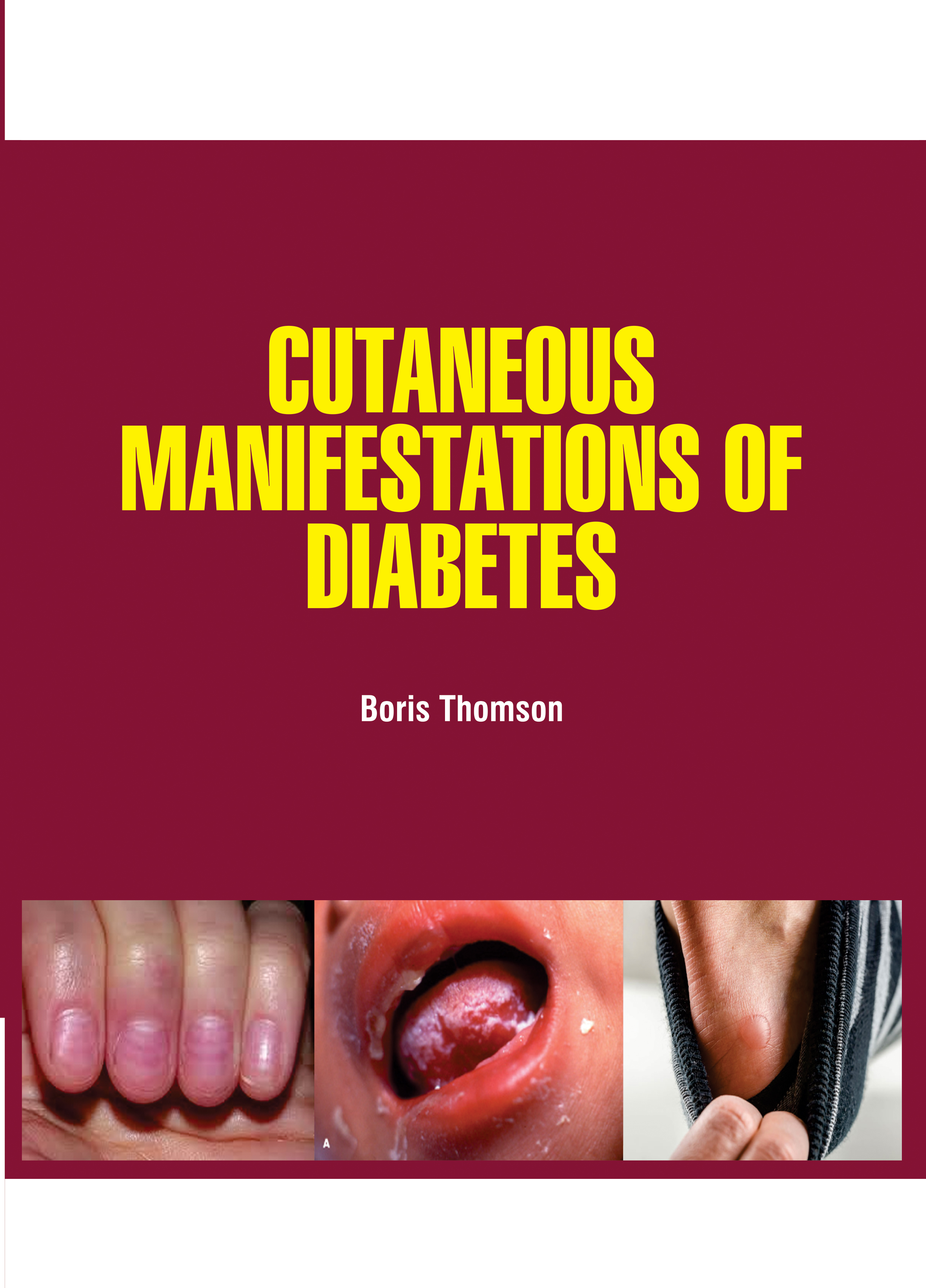 Cutaneous Manifestations of Diabetes
