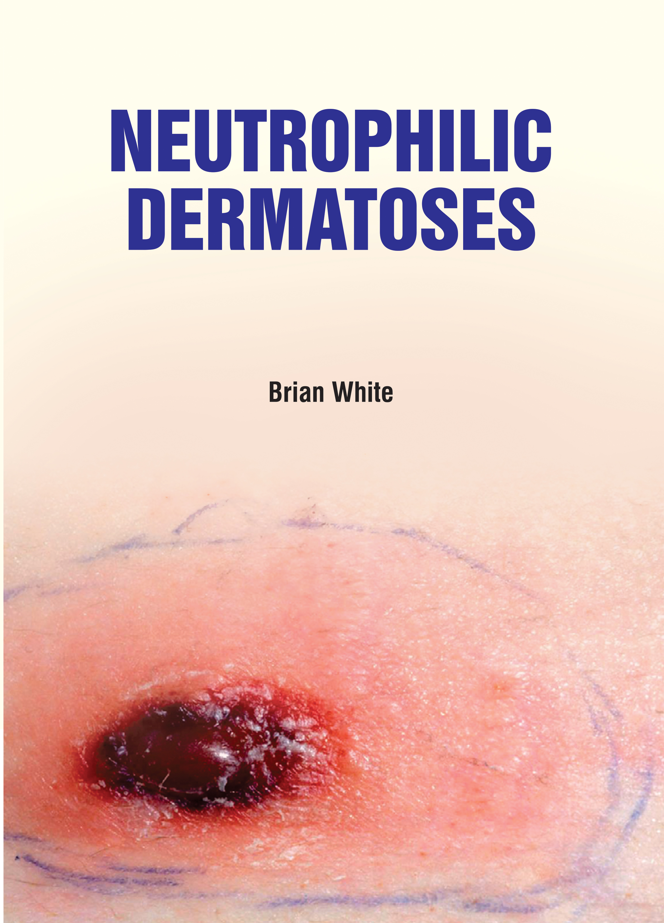 Neutrophilic Dermatoses