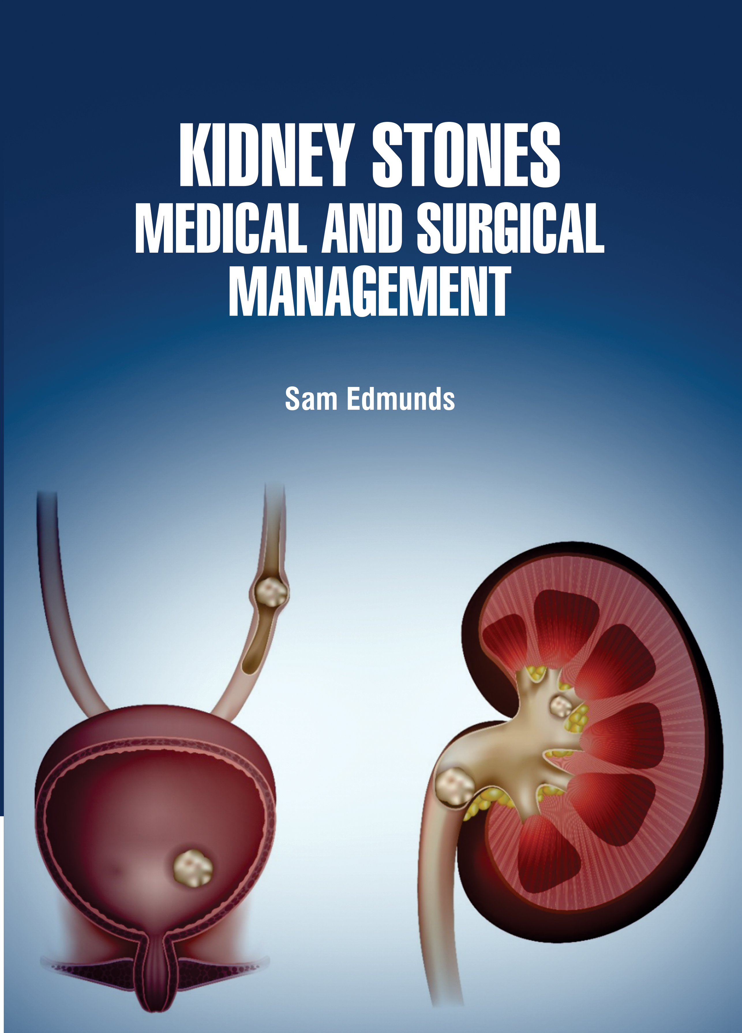 Kidney Stones: Medical and Surgical Management