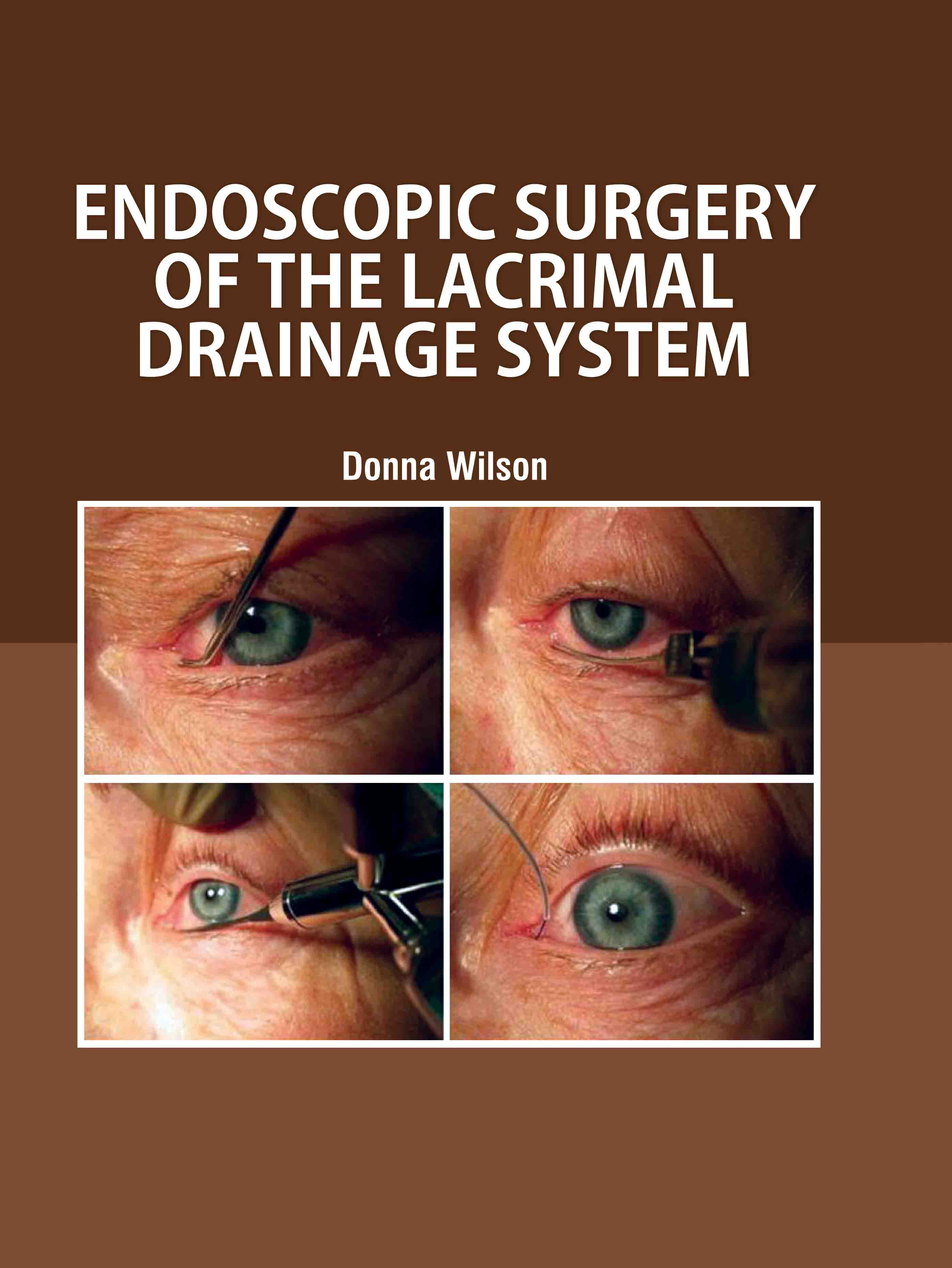 Endoscopic Surgery of The Lacrimal Drainage System