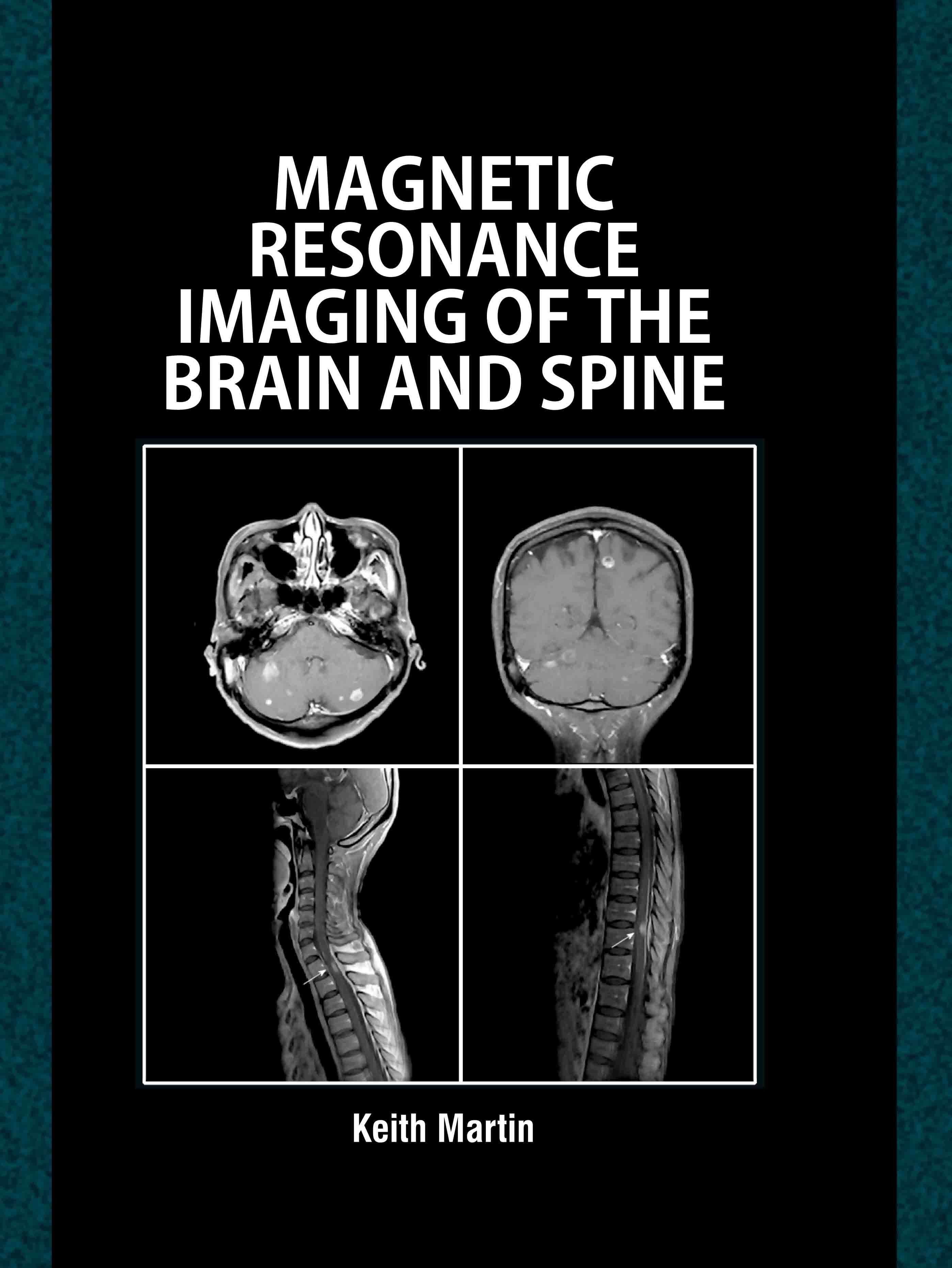 Magnetic Resonance Imaging of The Brain and Spine