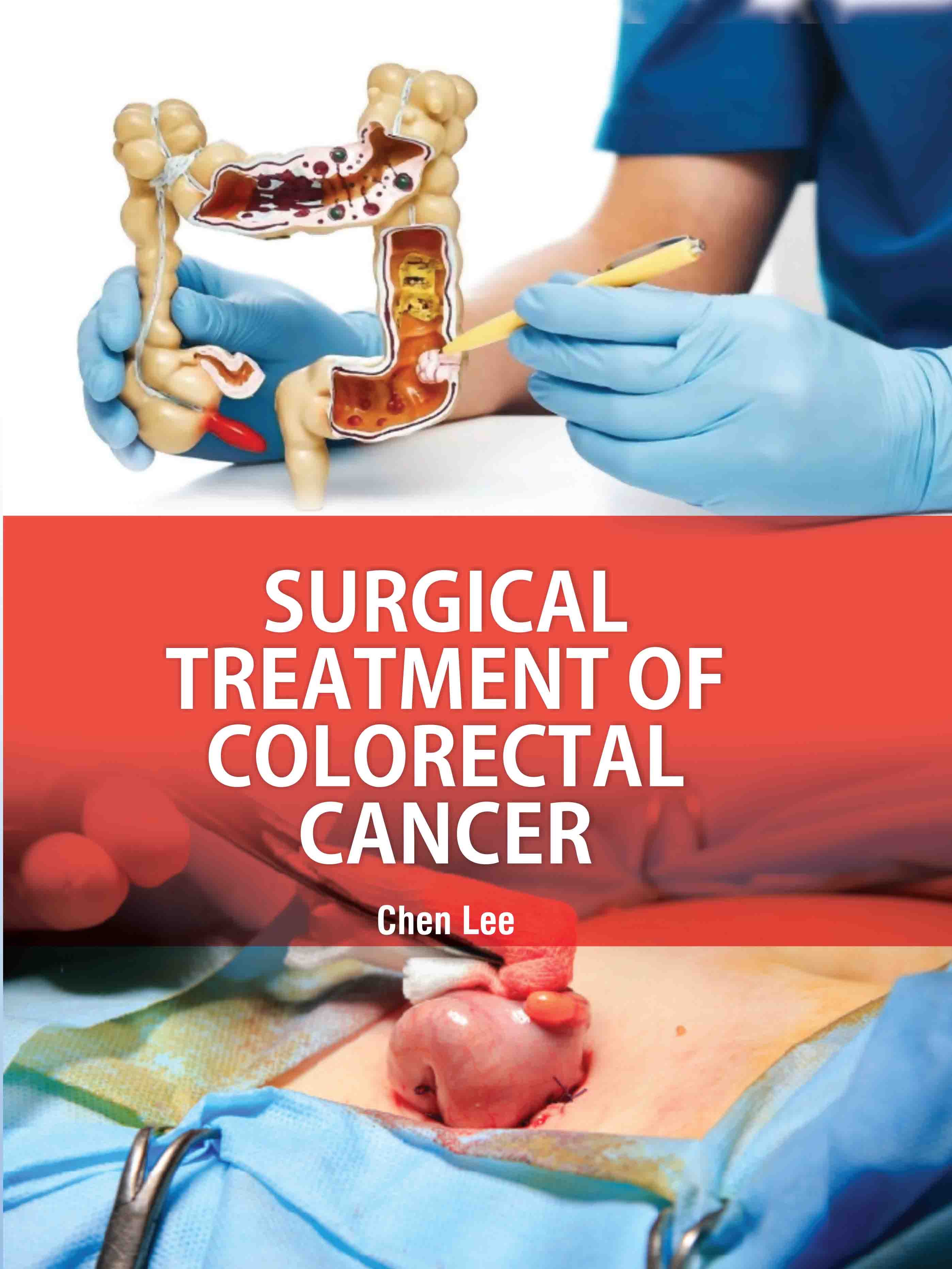 Surgical Treatment of Colorectal Cancer