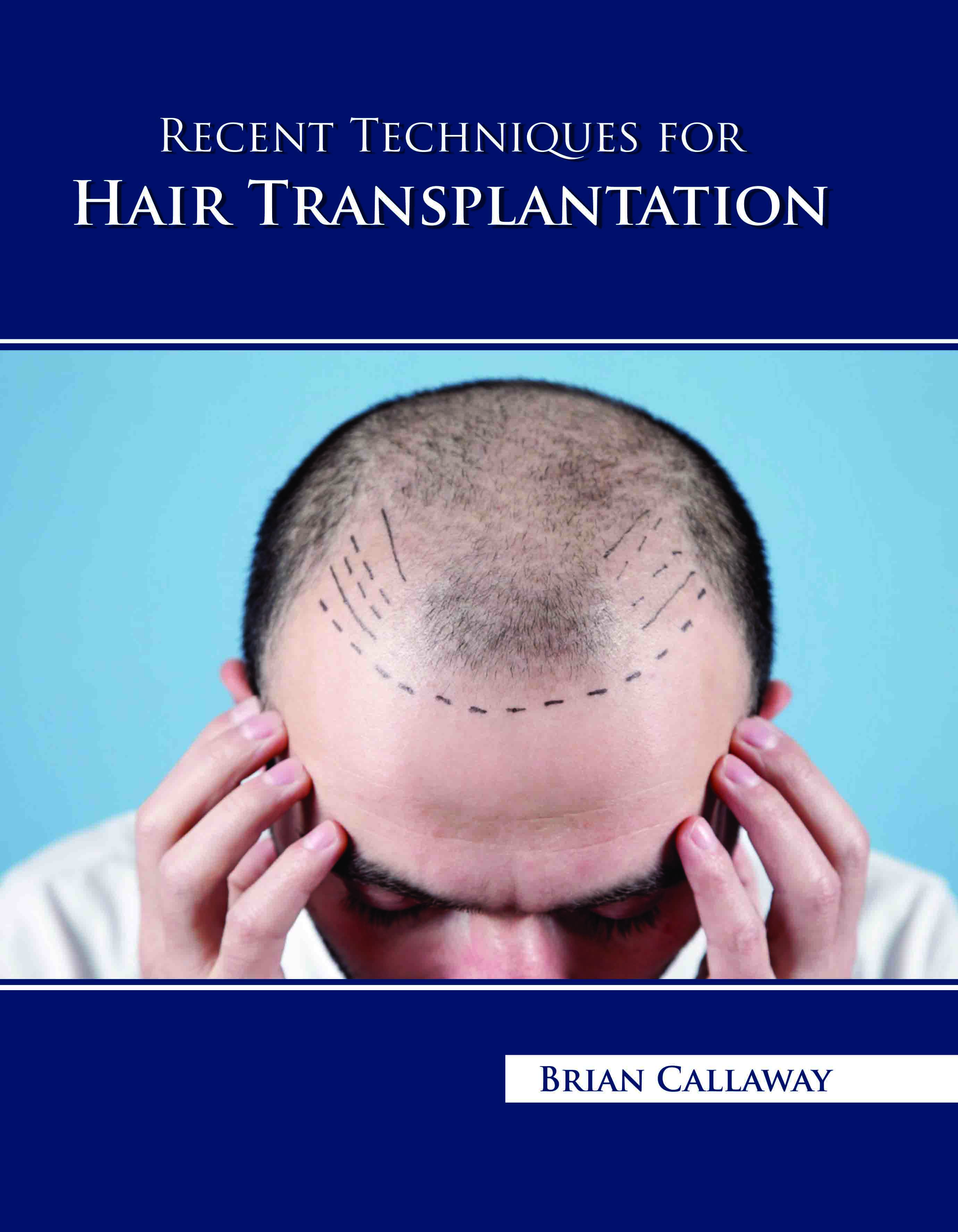 Recent Techniques for Hair Transplantation