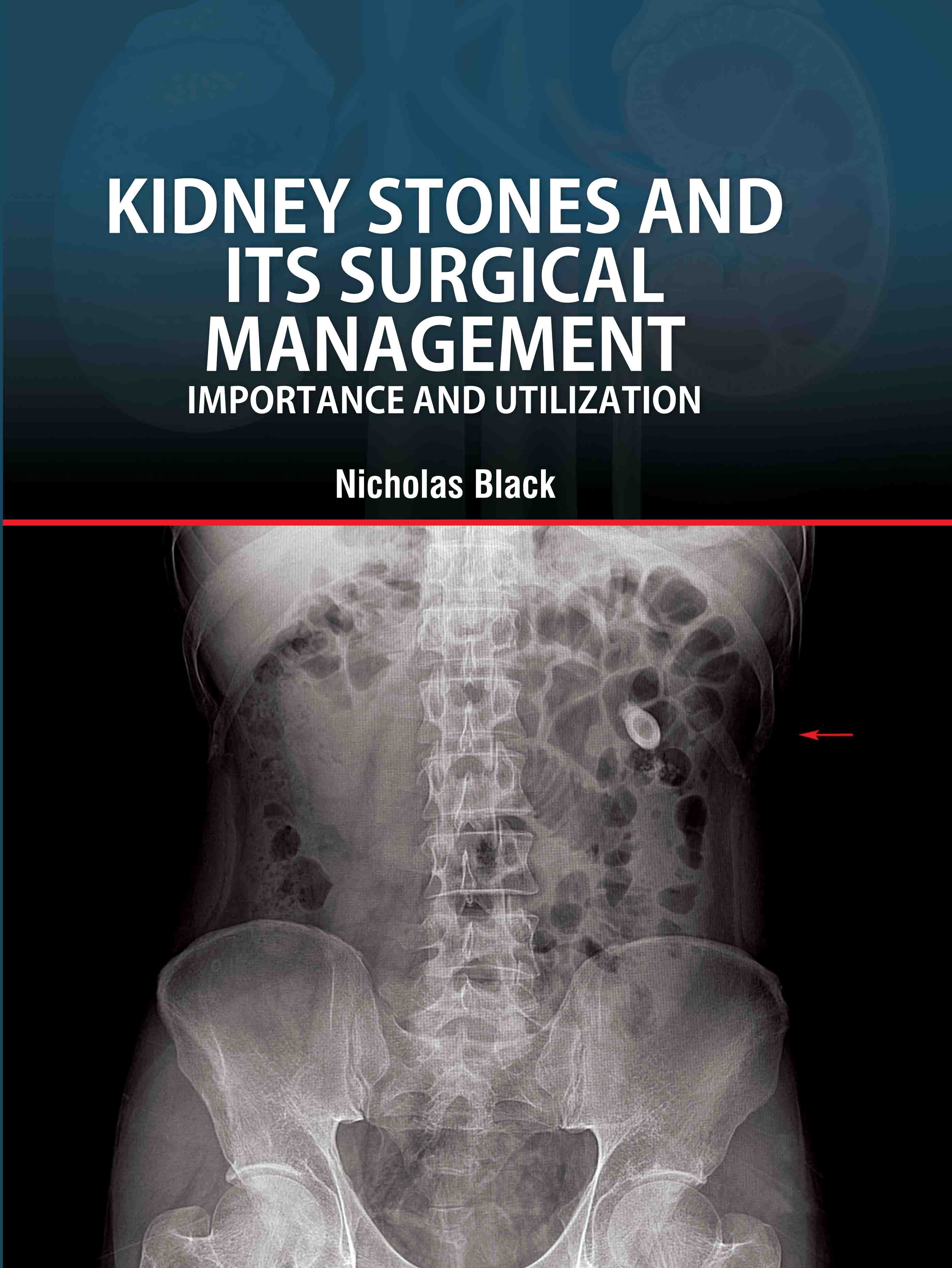 Kidney Stones and Its Surgical Management: Importance and Utilization