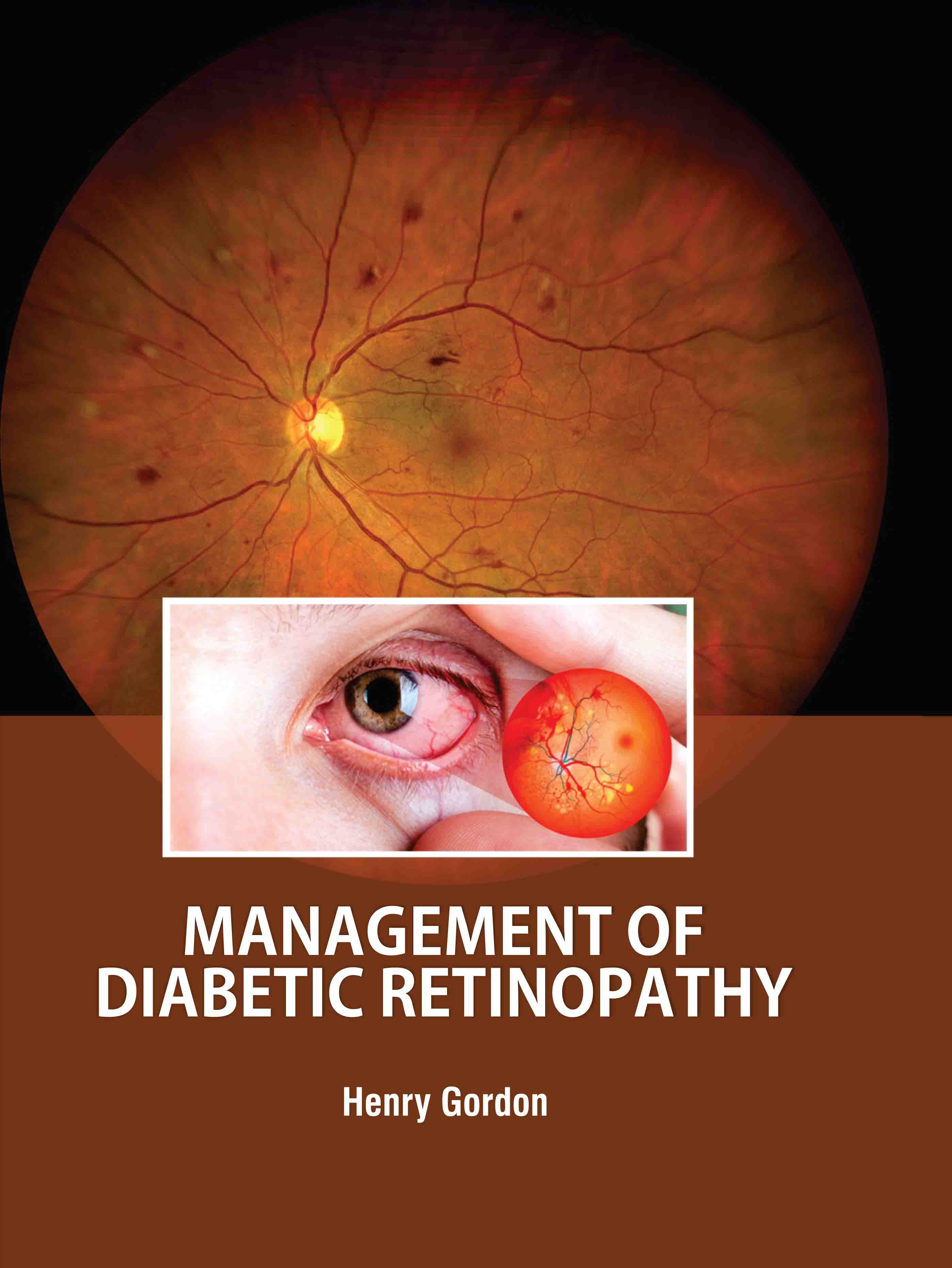 Management of Diabetic Retinopathy