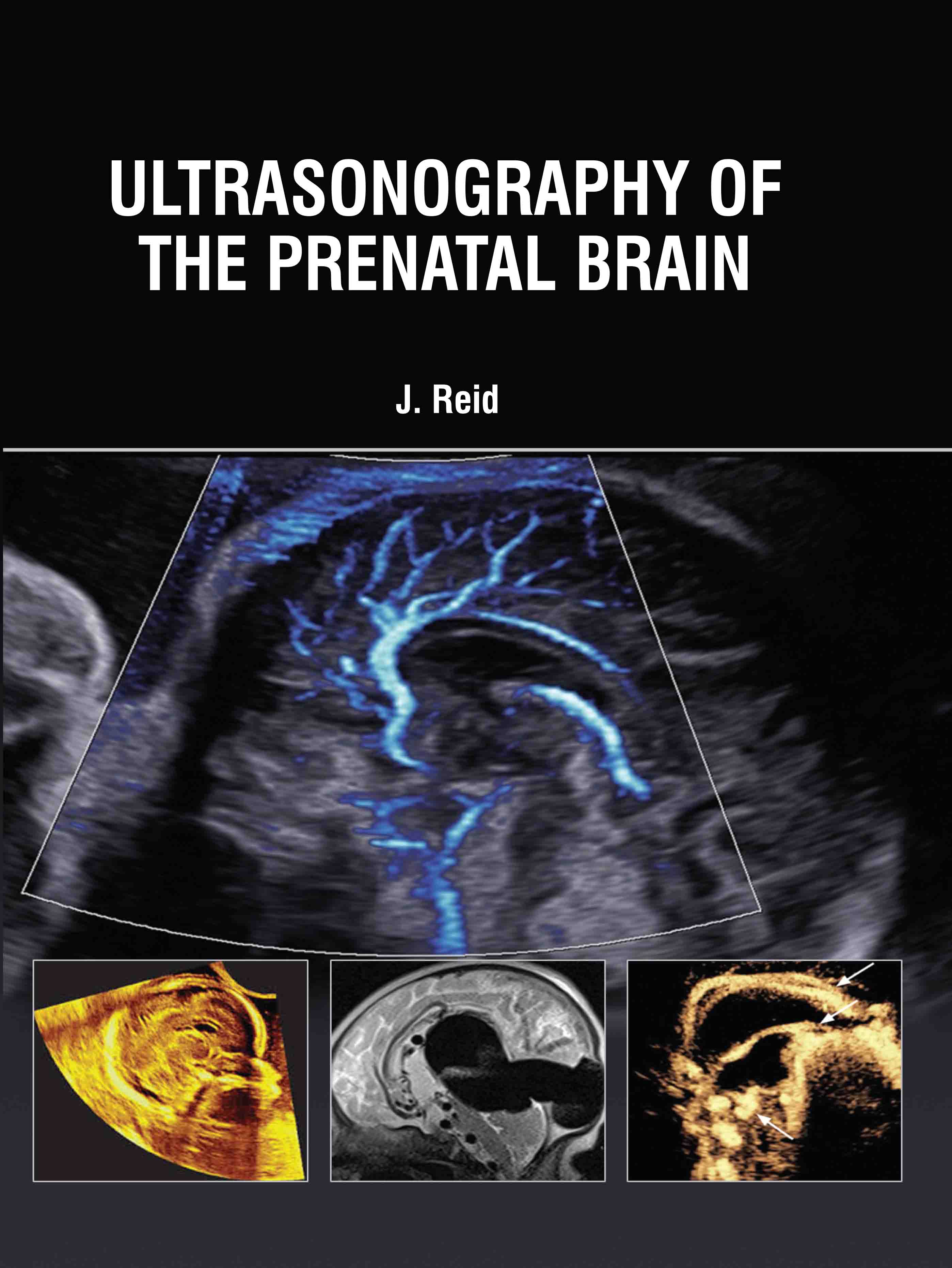 Ultrasonography of The Prenatal Brain