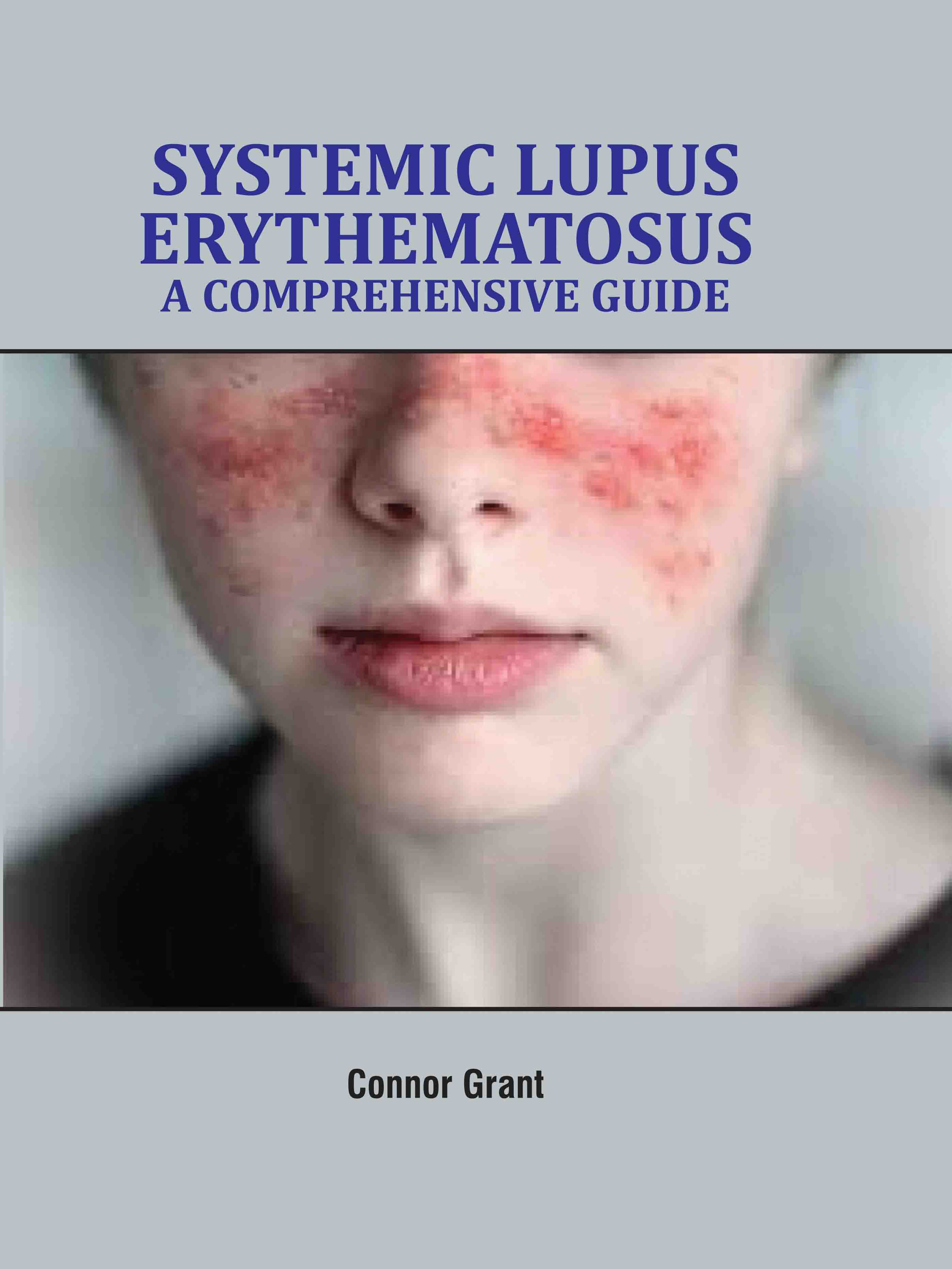 Systemic Lupus Erythematosus: A Comprehensive Guide