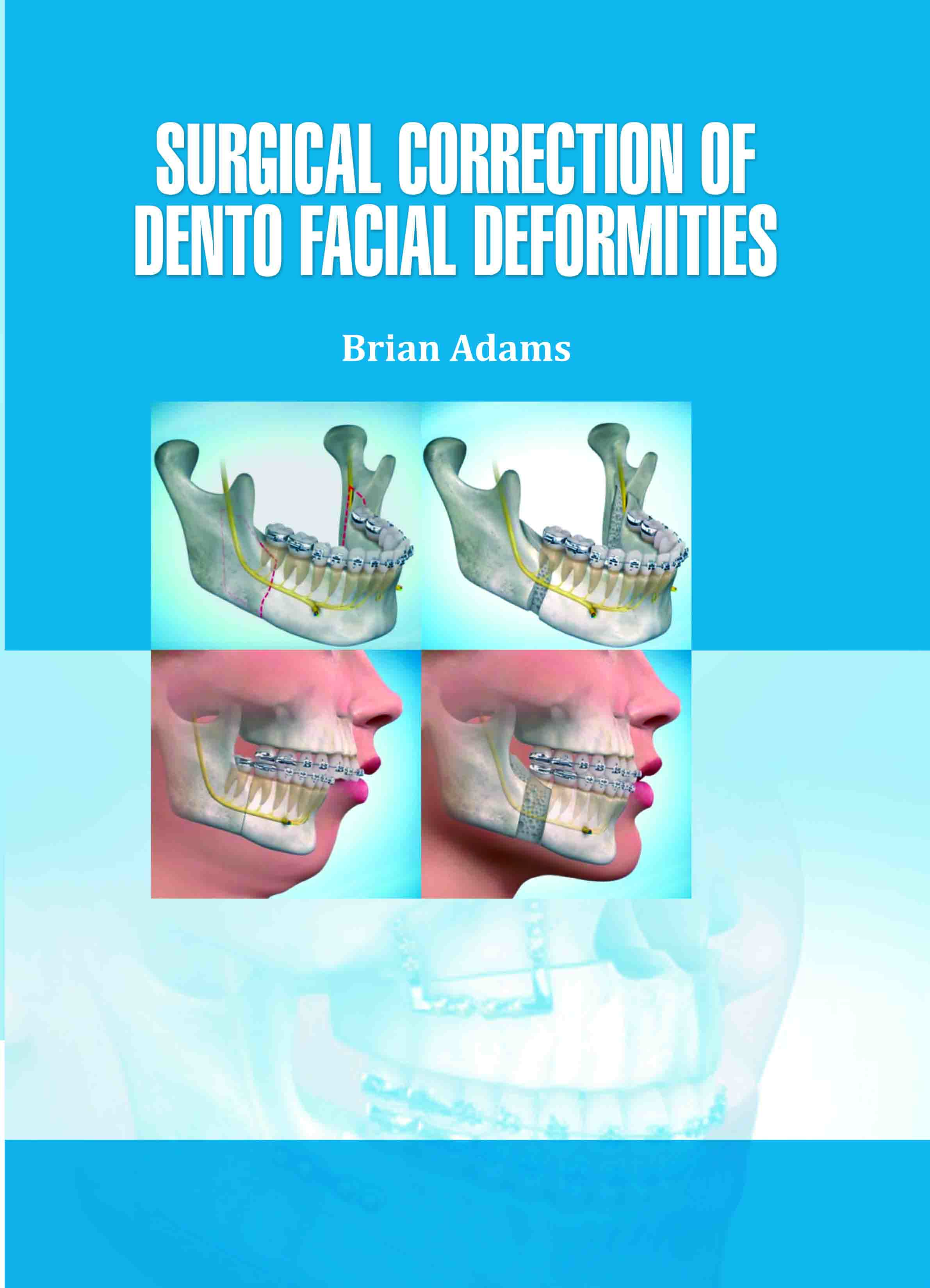 Surgical Correction of Dento Facial Deformities