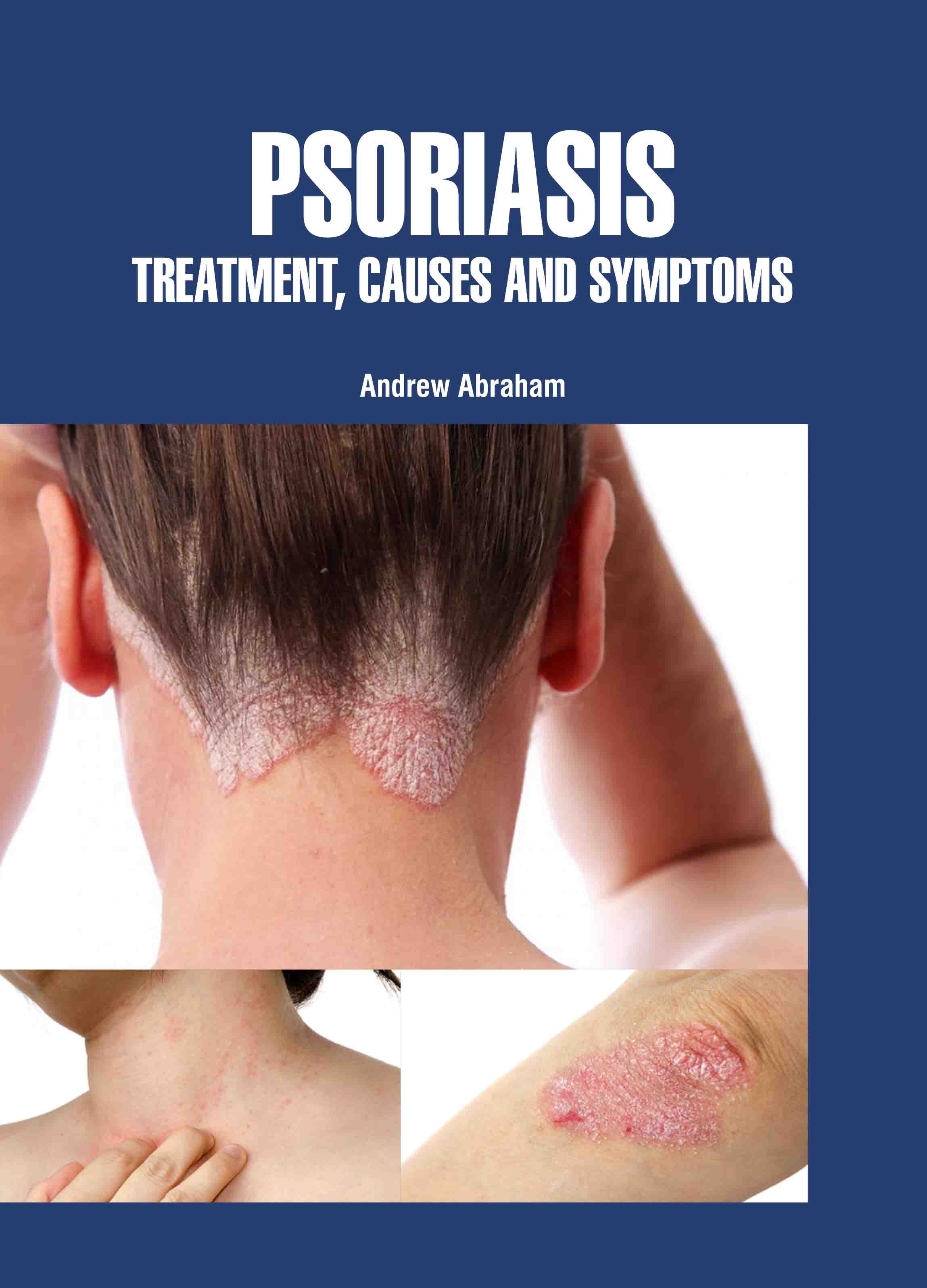 Psoriasis: Treatment, Causes and Symptoms